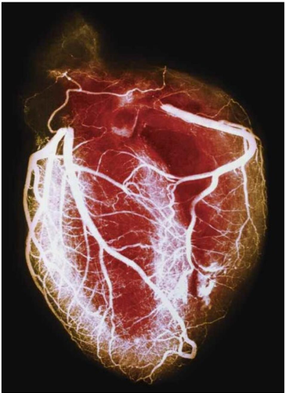 angiogram